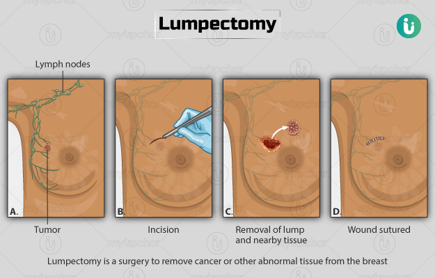 Opciones de cirugía de cáncer de mama: lumpectomía