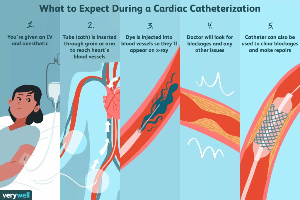 Cateterismo cardíaco en Canadá: qué esperar y cuándo es necesario
