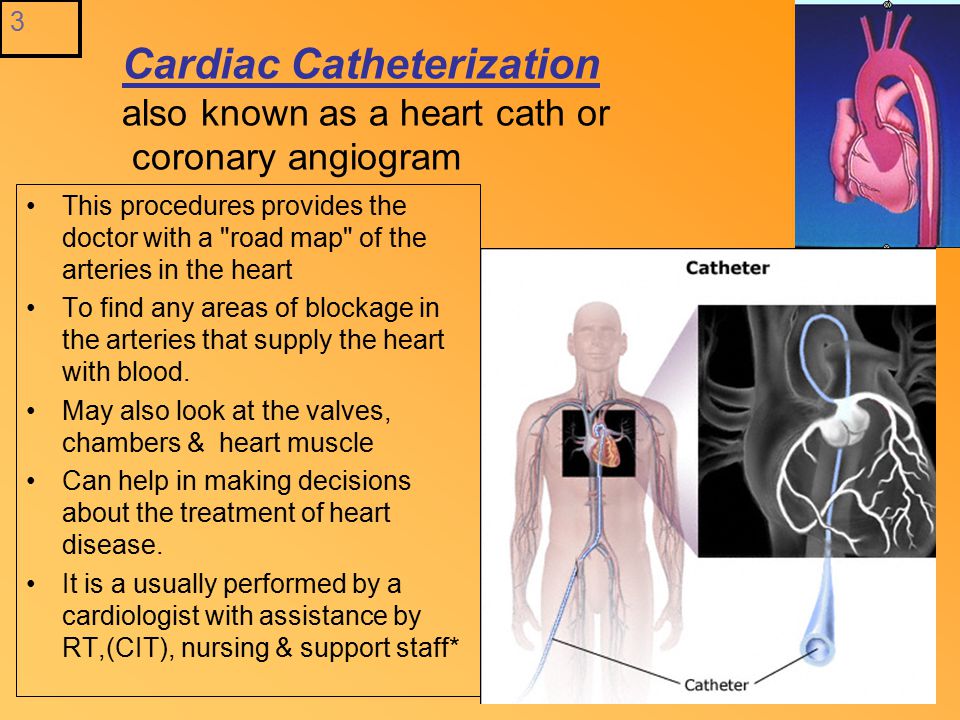 Cateterismo cardíaco en Canadá: cuando es necesario