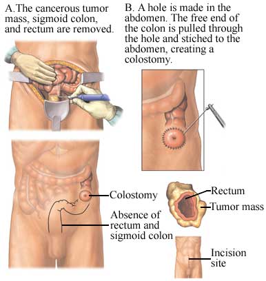 Colorectal Cancer Surgery in Canada: Surgical Procedures and Recovery Tips