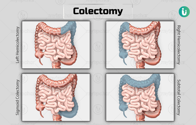 Colorectal Cancer Surgery in Canada- colectomy