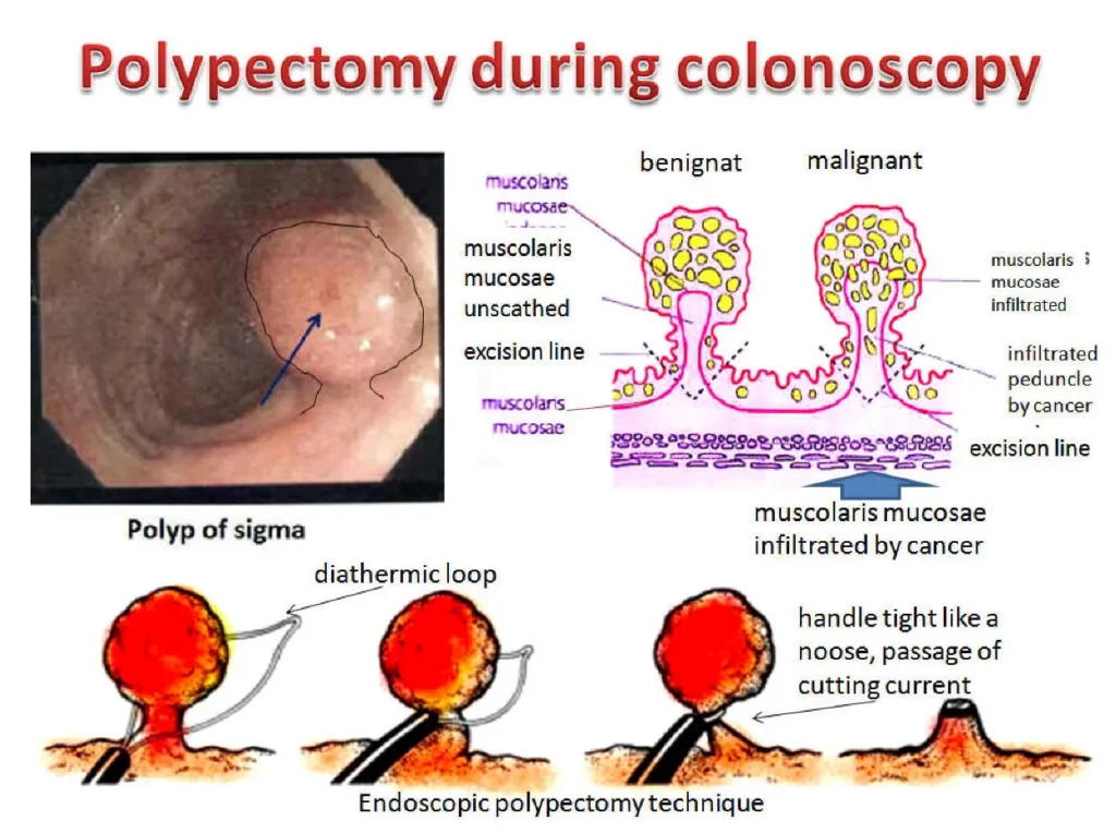 Colorectal Cancer Surgery in Canada- polypectomy