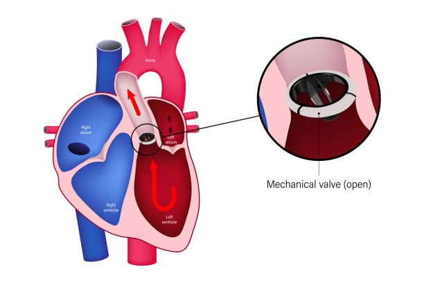 Замена и ремонт сердечного клапана: процедуры и восстановление в Канаде