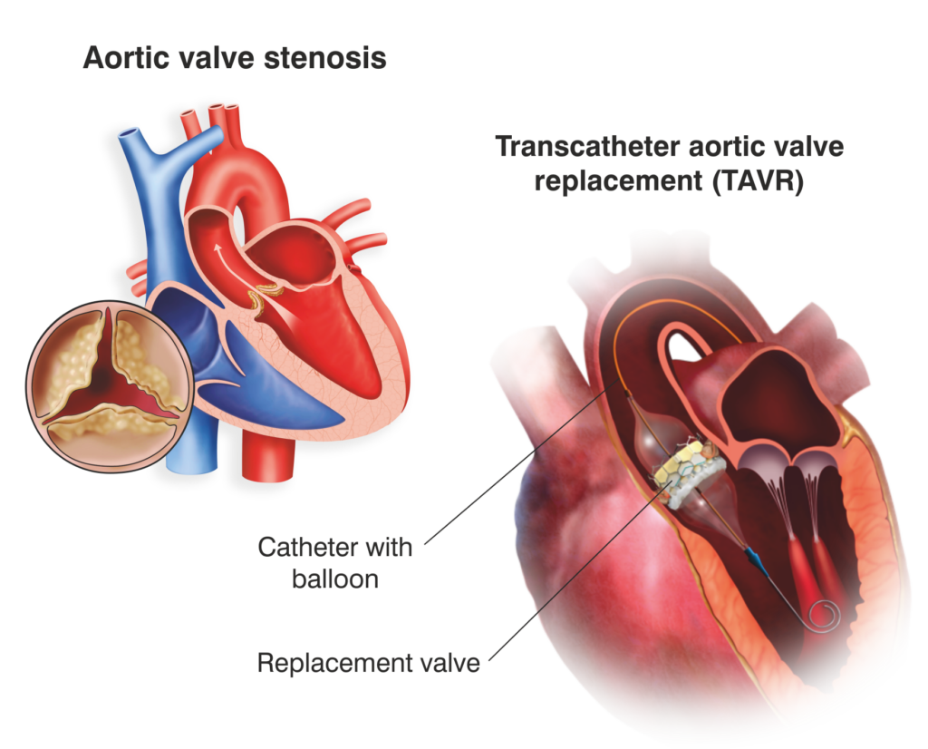 Herzklappenersatz und -reparatur – TAVR