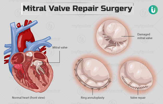 Herzklappenersatz und -reparatur – Operation zur Reparatur der Mitralklappe