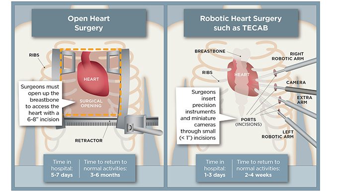 Minimalinvasive Herzoperationen – Optionen verfügbar