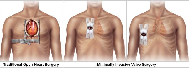 Minimalinvasive Herzoperationen – Optionen verfügbar