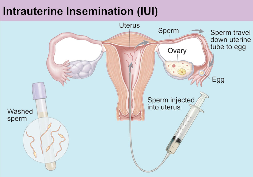 Varicocele and Assisted Reproductive Technologies- IUI