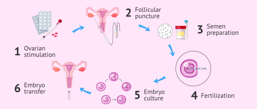 Varicocele and Assisted Reproductive Technologies- IVF