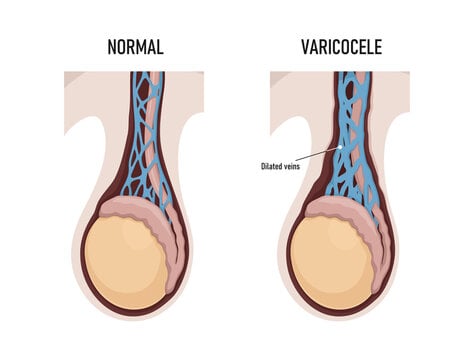 Varicocele and Assisted Reproductive Technologies ART