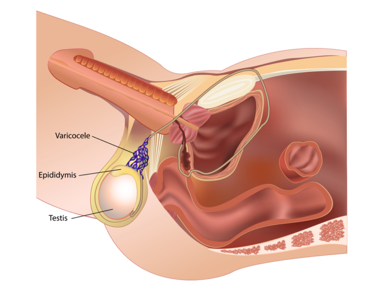Varicocele and Male Infertility in Canada: Best Treatment Options