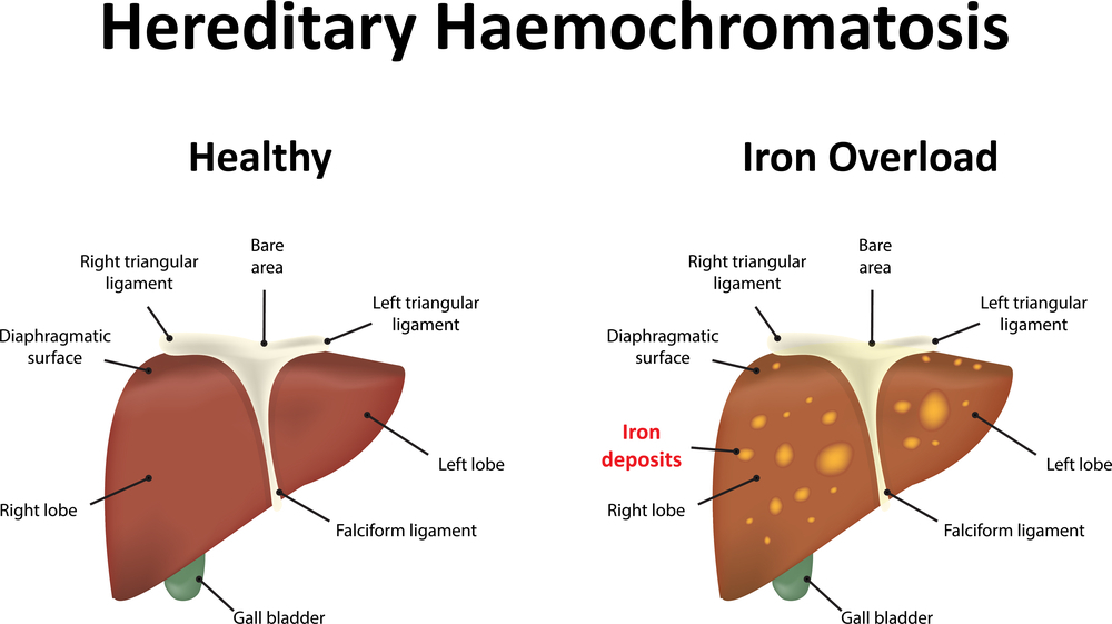 Tratamiento de la hemocromatosis: causas