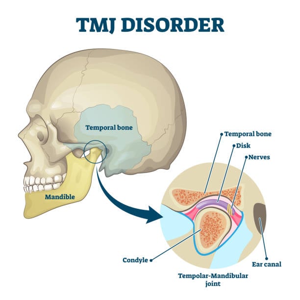 Traitements du dysfonctionnement de l'articulation temporo-mandibulaire