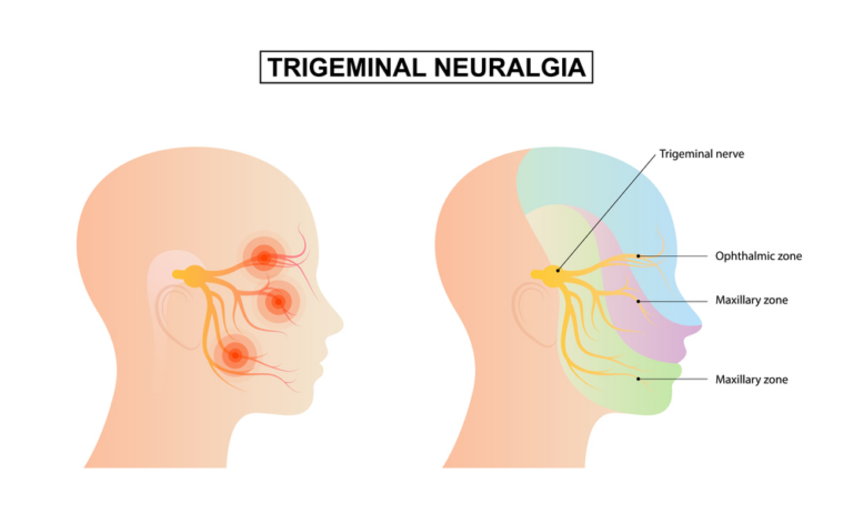 Tratamiento de la neuralgia del trigémino