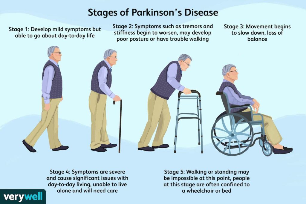 Ce qui rend Israël le meilleur pour le traitement de la maladie de Parkinson et de l'épilepsie : stades de la maladie de Parkinson