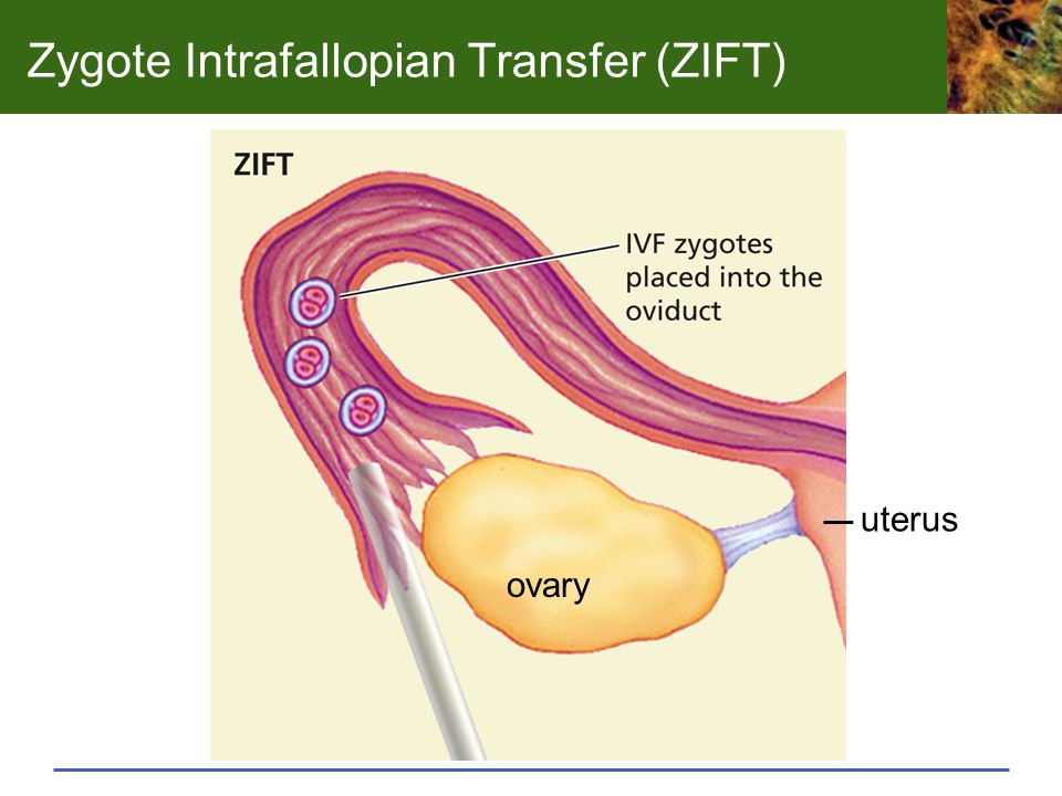 Who Is a Good Candidate for ZIFT Reproductive Technology image