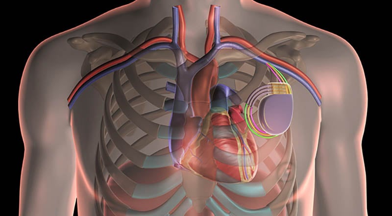 Dispositifs implantables pour les maladies cardiaques - CRT