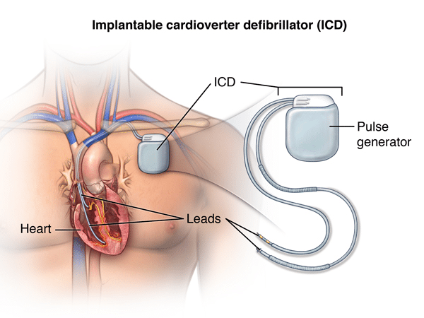 Dispositifs implantables pour les maladies cardiaques - ICD