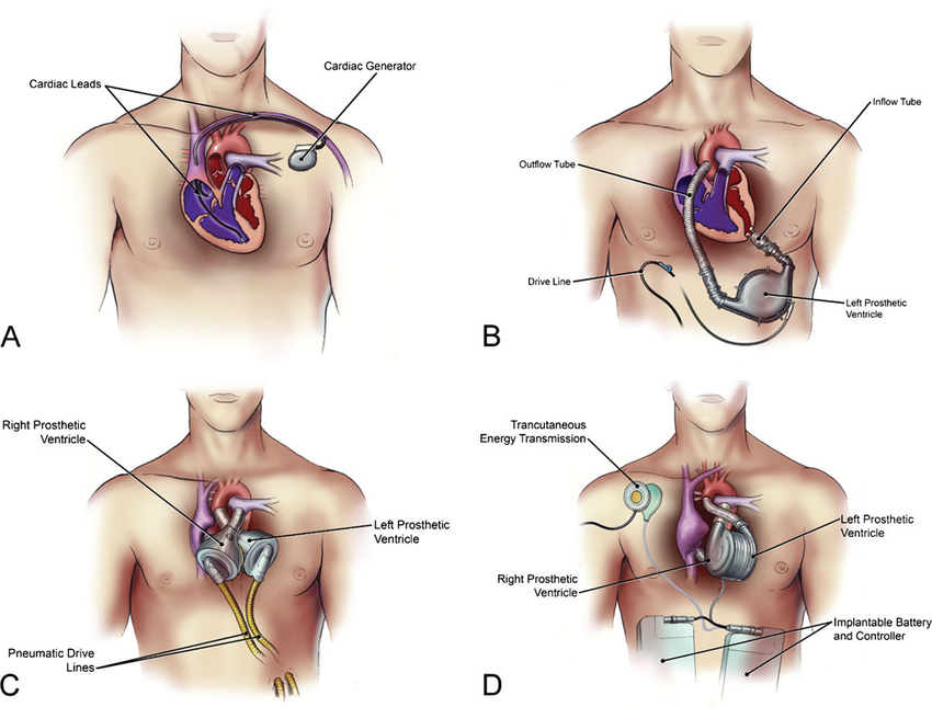 الأجهزة القابلة للزرع لأمراض القلب