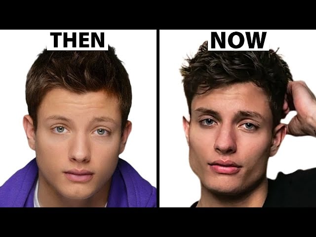 Cirugía plástica de Matt Rife: fotos de antes y después