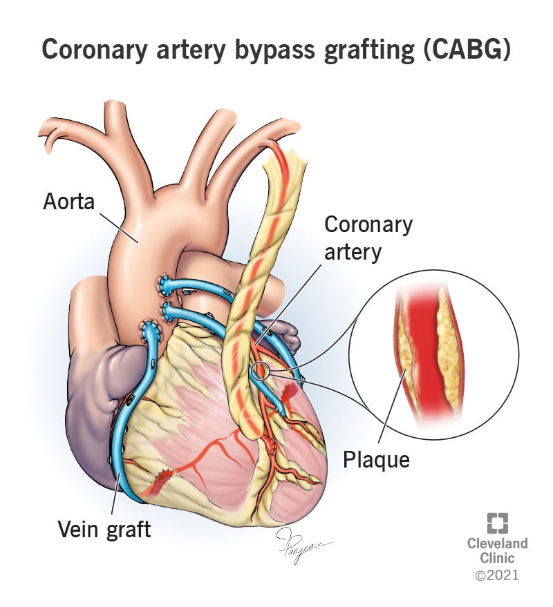Cirugía cardíaca de Paul Lavadora: cirugía de bypass de arteria coronaria