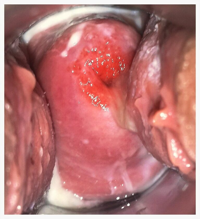 Ectropión Cervical