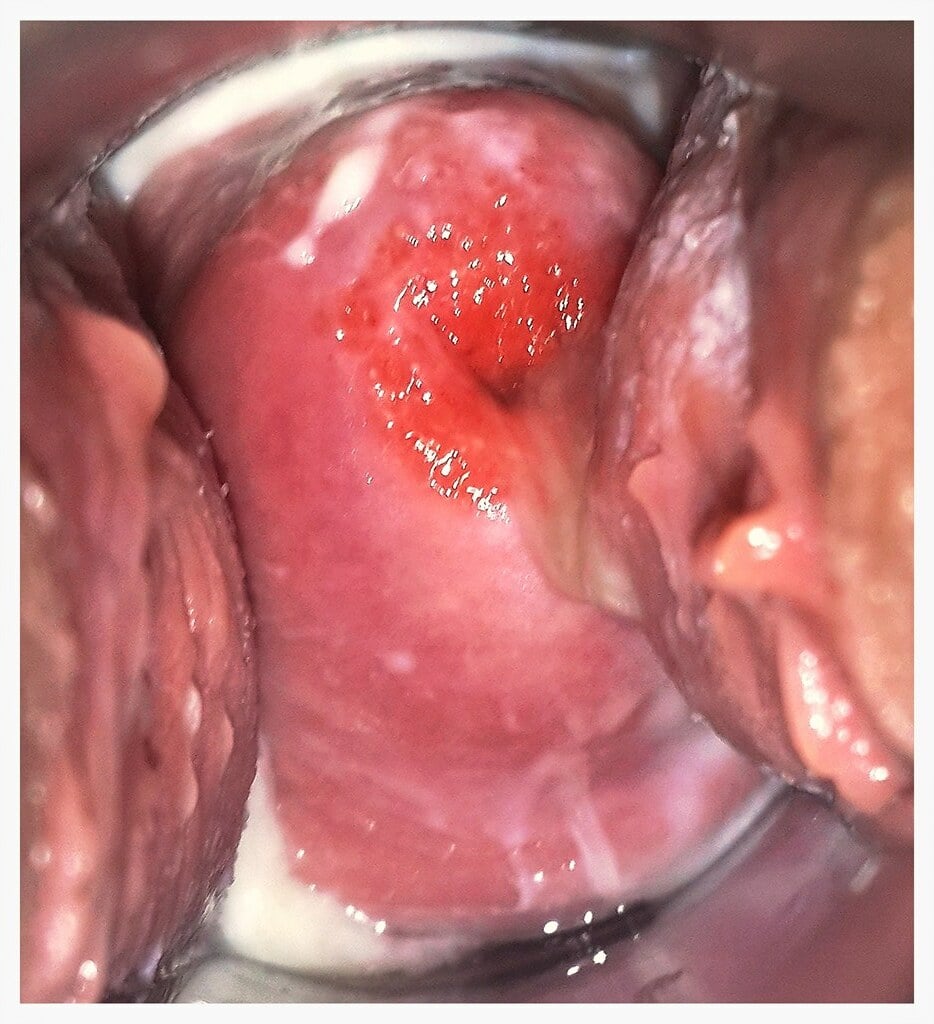 Ectropion cervical